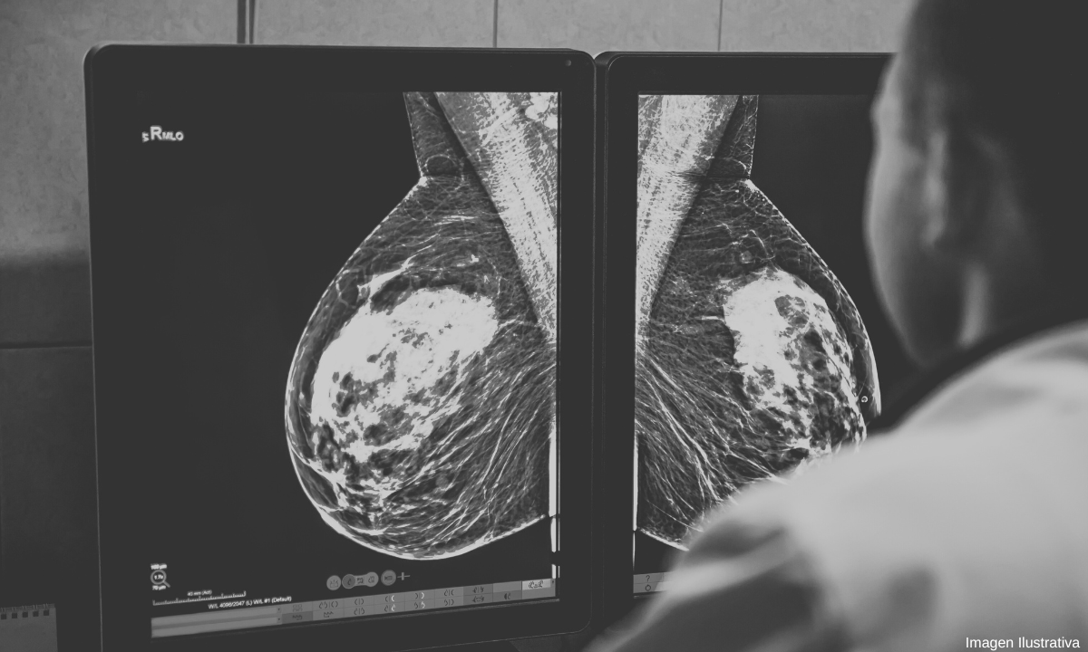 Expertos recomienda hacer mamografías a partir de los 40 años