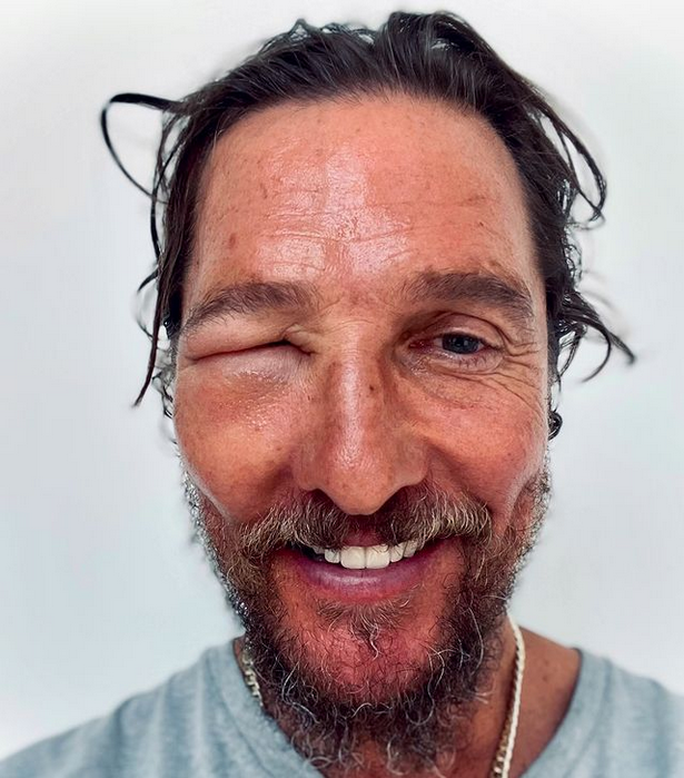 Matthew McConaughey "desfigurado" tras picadura de abeja