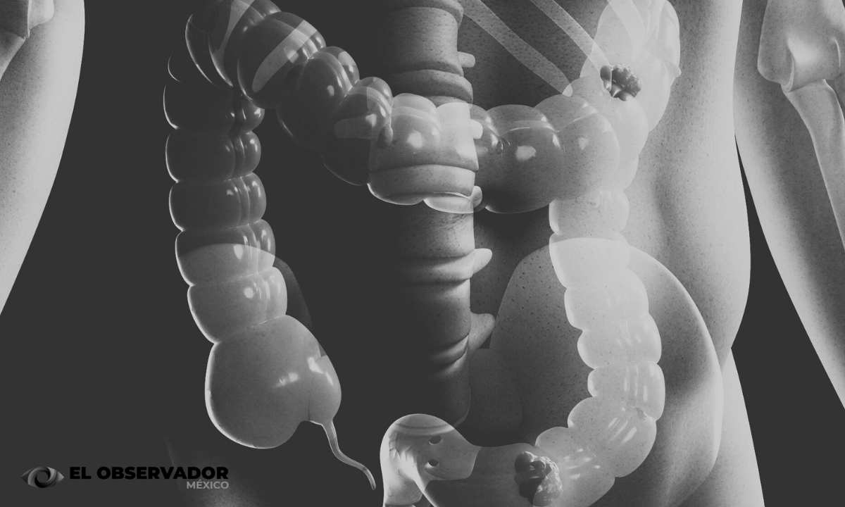 Cáncer intestinal aumenta entre jóvenes de todo el mundo