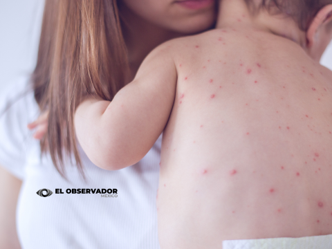 El sarampión ya se extendió por todo México