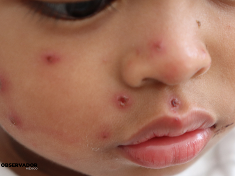 Acumula Sonora 113 casos de sarampión entre 2025 y 2026