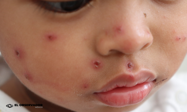 Acumula Sonora 113 casos de sarampión entre 2025 y 2026